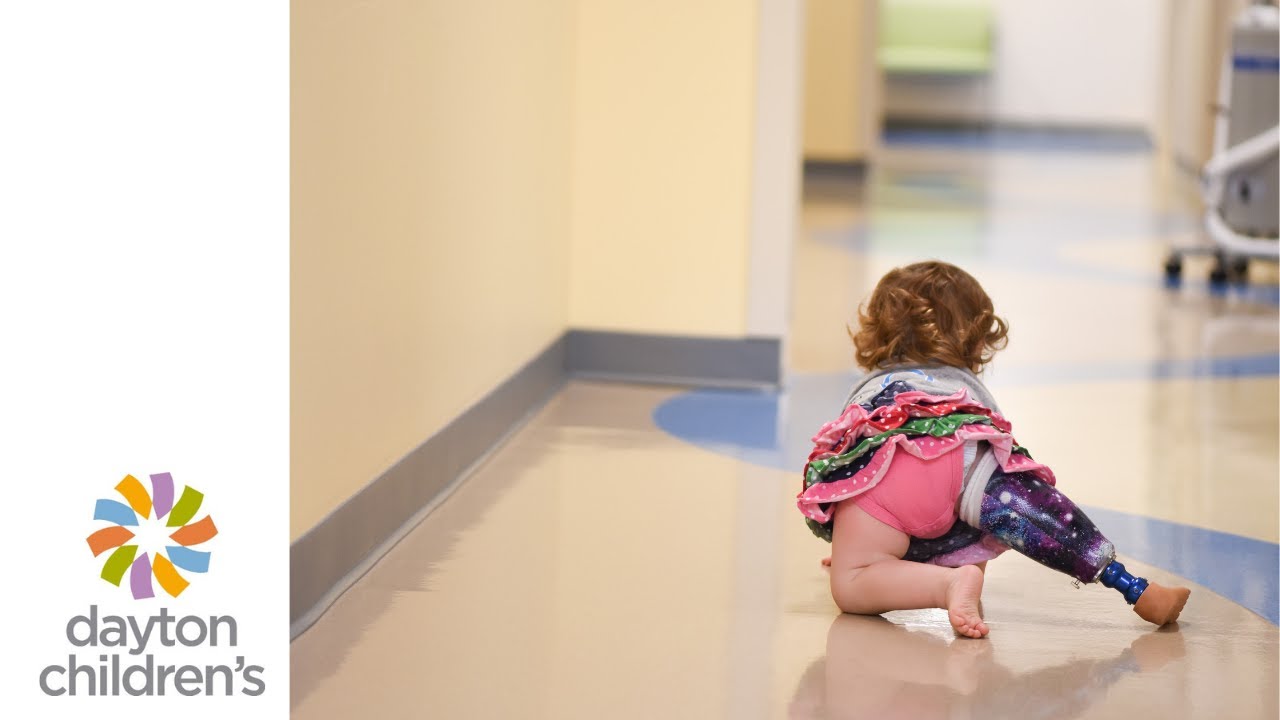 One in a million: baby born without tibia learns to live with amputated leg