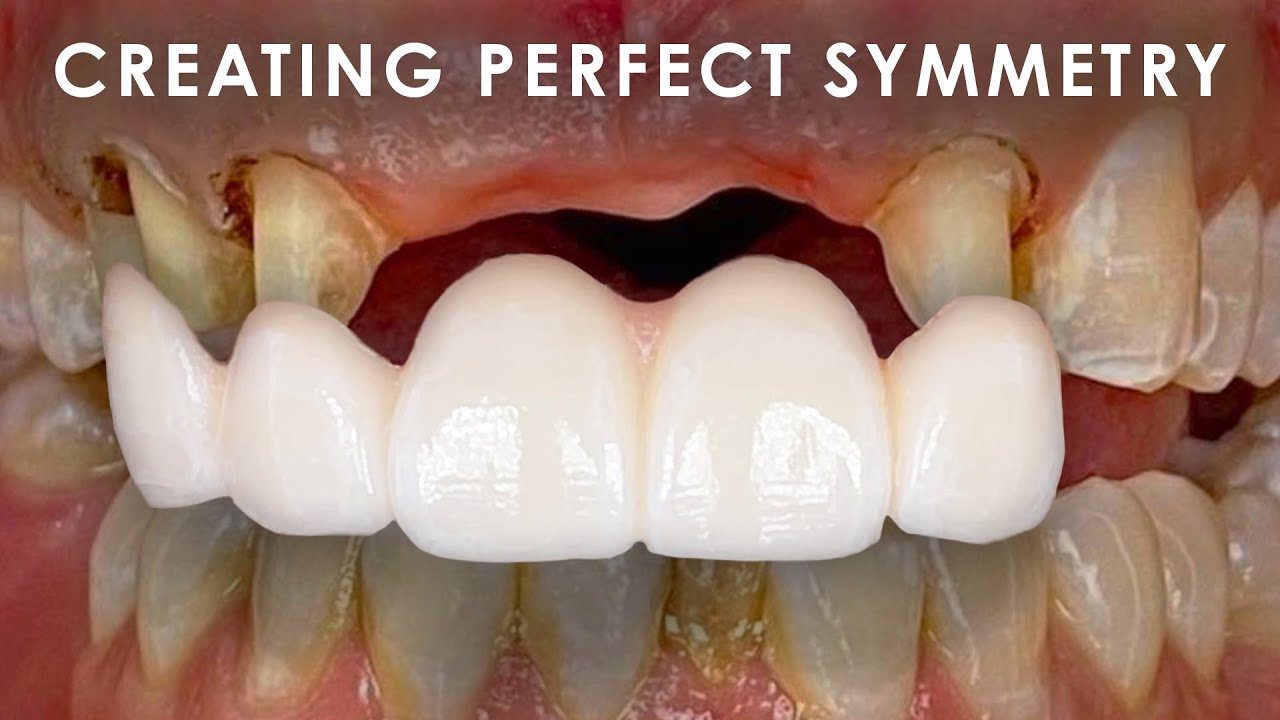 Creating Perfect Symmetry for Zirconia Bridges