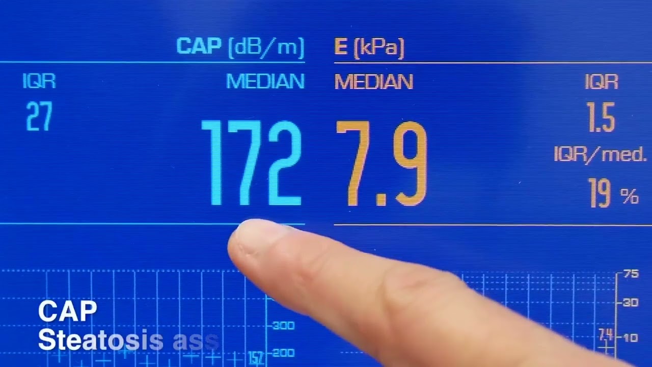 How To Do a FibroScan Examination - Tutorial