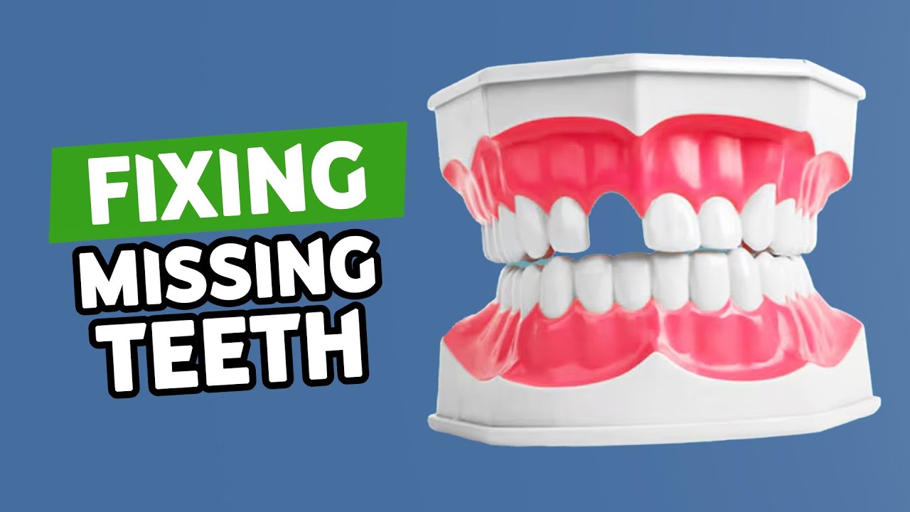 Restoring Missing Teeth: Bone Grafting for Dental Implants