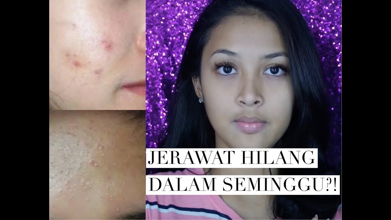 Night Skin Care Routine For Acne & Oily Skin | Delmira Anggita