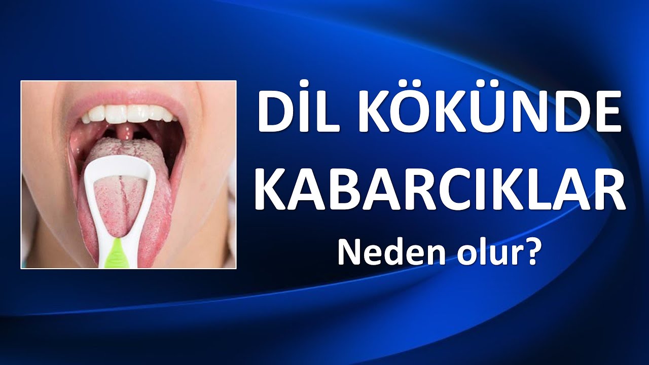 DİL KÖKÜNDE KABARCIKLAR