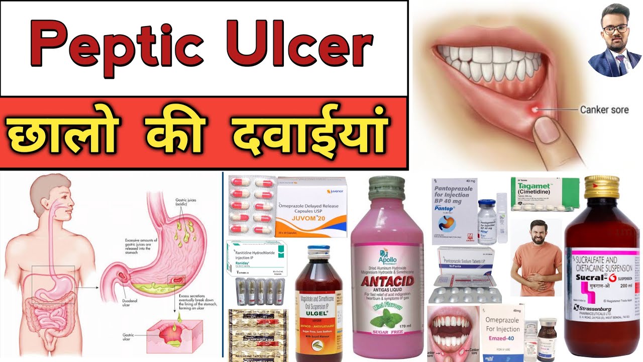 Peptic Ulcer | Gastric Ulcer | Treatment | Medicine | Injection | Pharmacy | Medical | दवाईयां