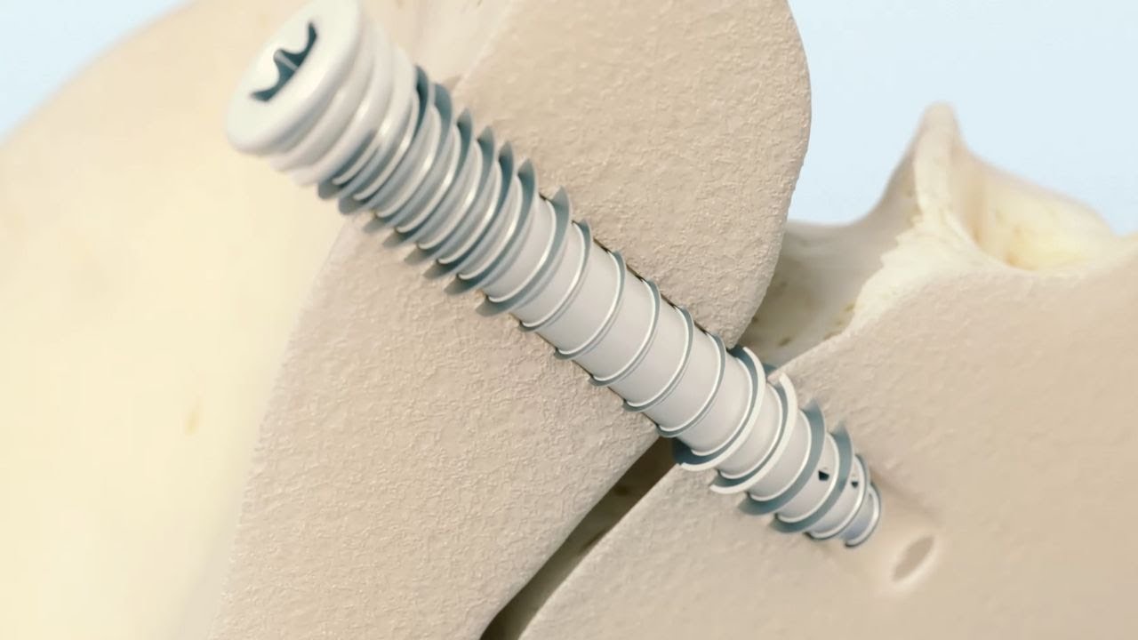 TransLoc 3D™ Patient Animation