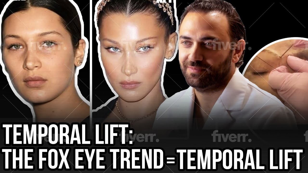 Temporal Brow Lift - Dr Sami Moubayed | FACE MD