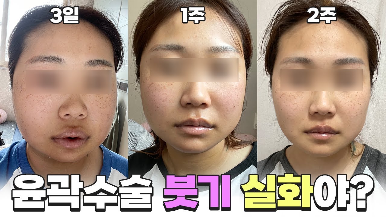 안면윤곽 수술 후 붓기와 회복기간, 케이스별로 알아보기(1일~30일)