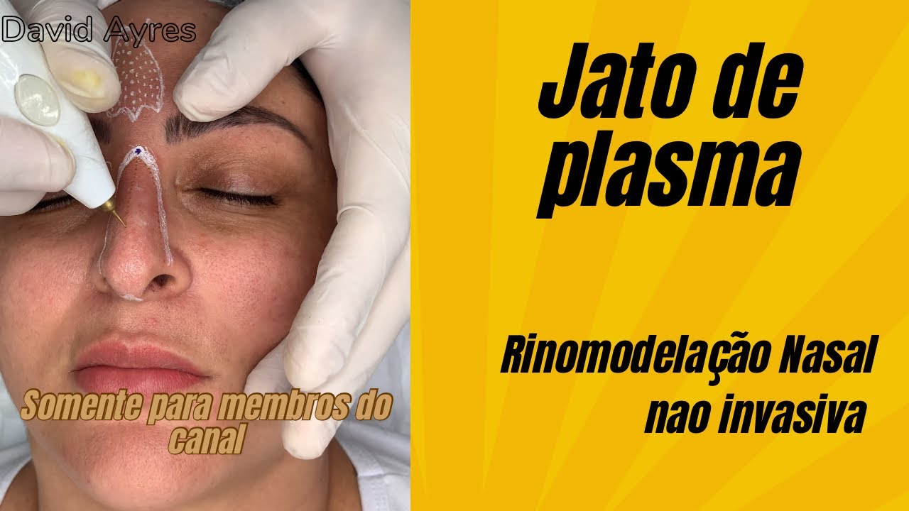 RINOMODELAÇÃO com jato de plasma