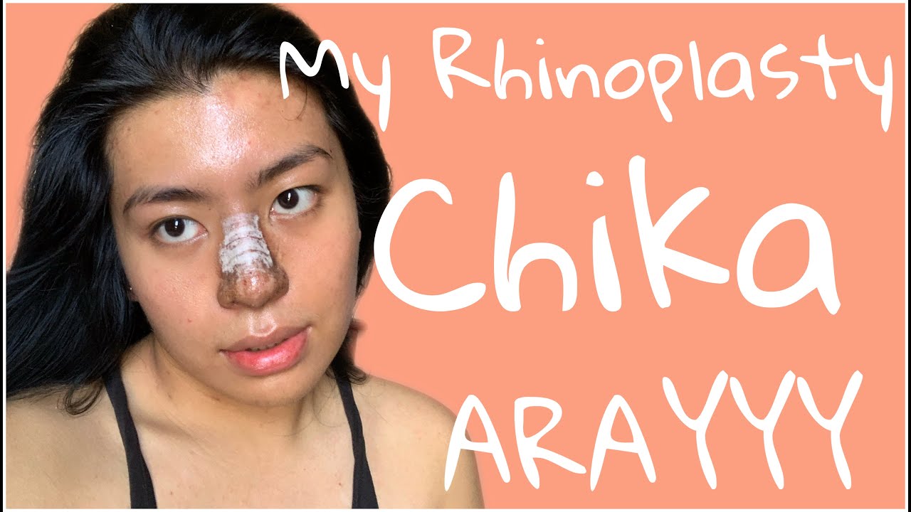 My experience in rhinoplasty in cebu / beauty centrale / bisaya