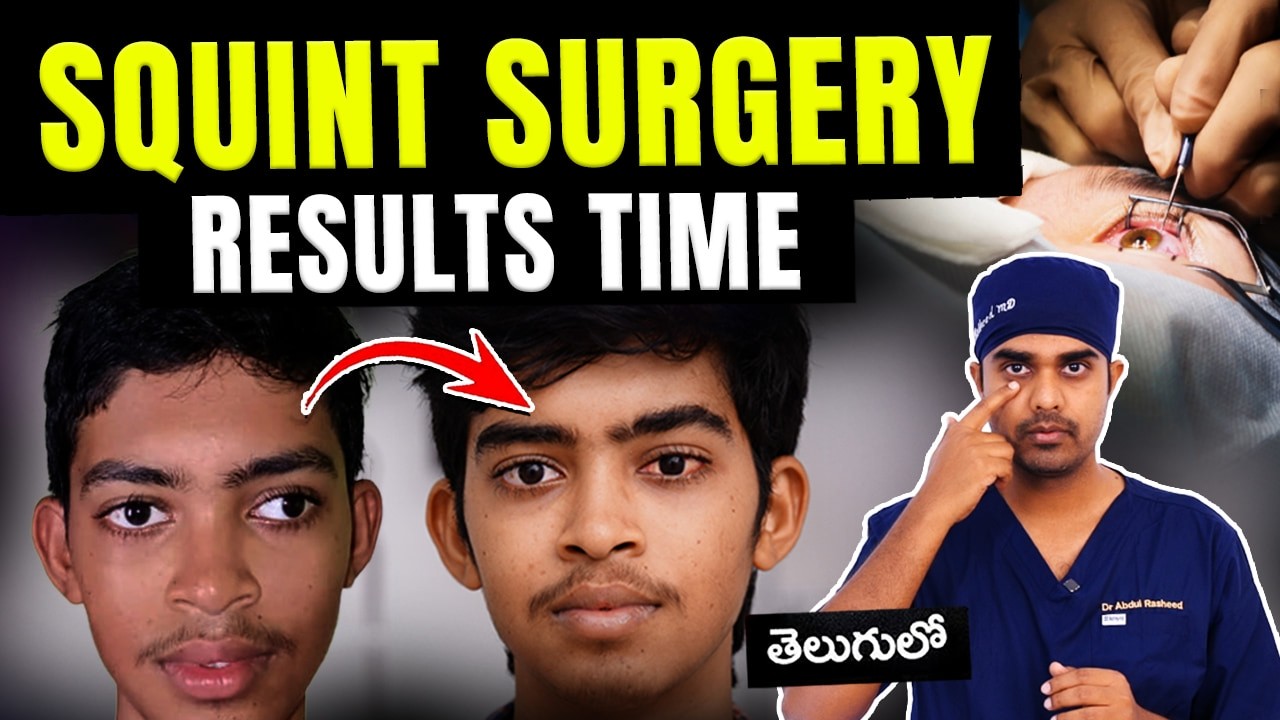 మెల్లకన్ను సర్జరీ తర్వాత కోలుకోవడానికి ఎంత సమయం పడుతుంది? | Squint surgery | Dr Abdul Rasheed
