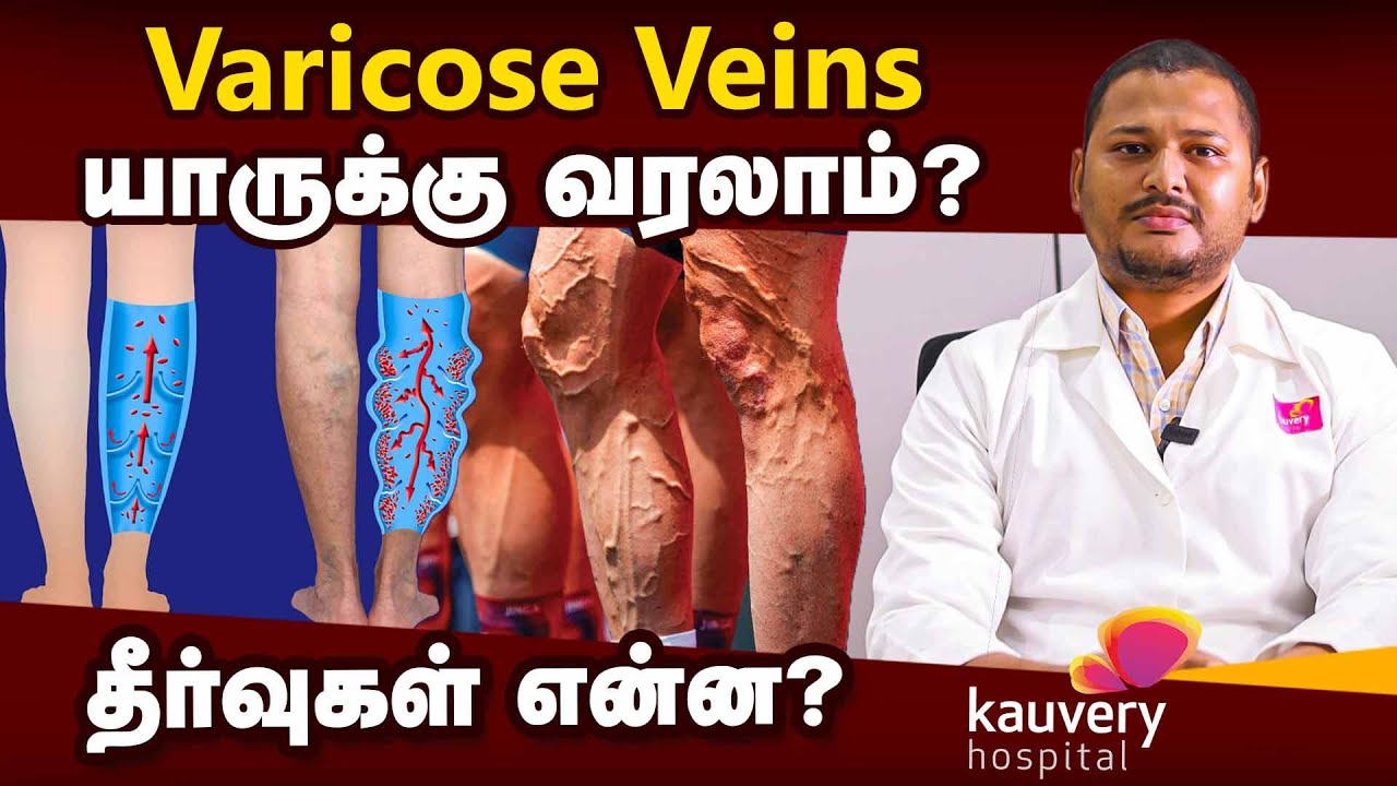 Varicose Veins - Causes, Symptoms, Prevention & Treatment