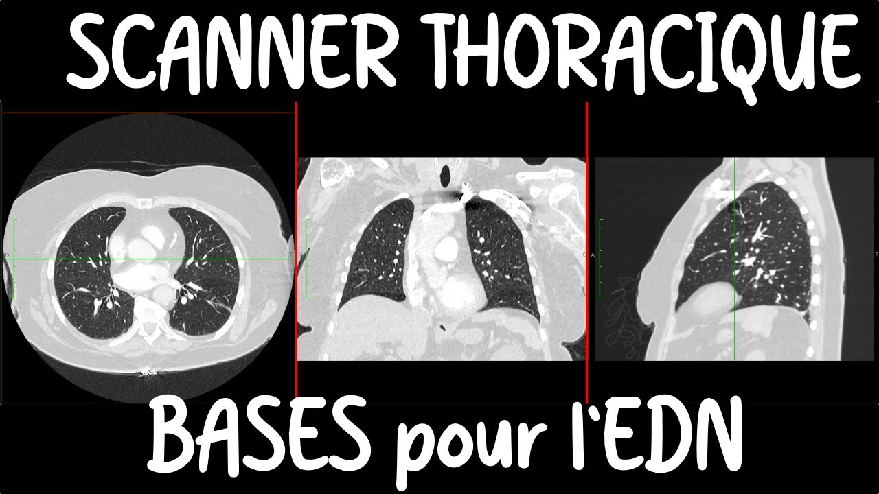 Les indispensable en SCANNER THORACIQUE pour l'EDN ( principes d'interprétation pour tout médecin )