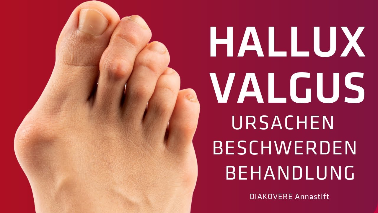 Hallux Valgus - Ursachen, Beschwerden, Behandlungsmöglichkeiten - DIAKOVERE Annastift