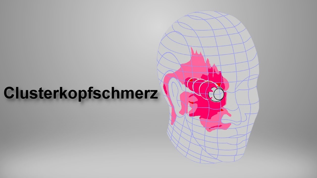 myREGIO.TV: Clusterkopfschmerz