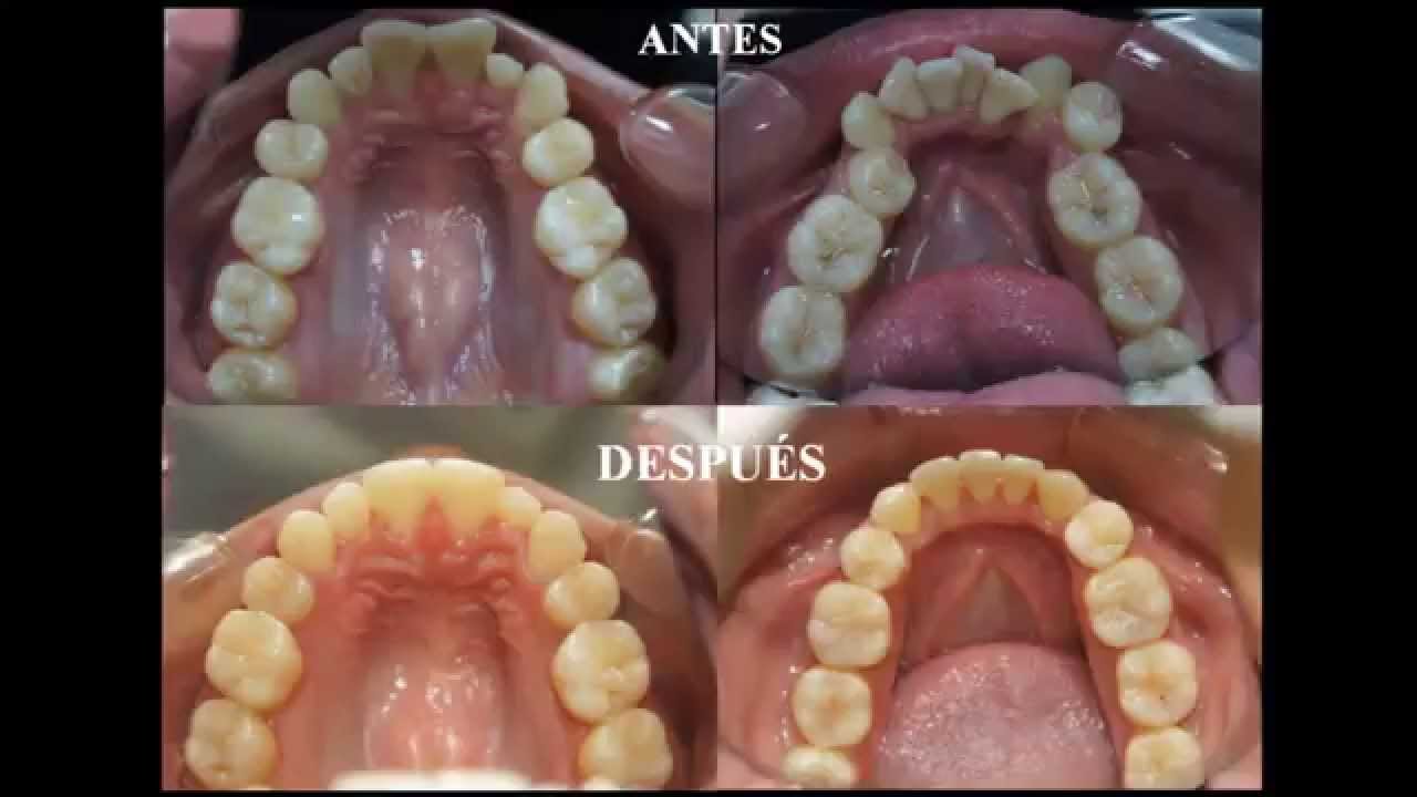 ORTODONCIA ANTES Y DESPUÉS. DR. JAVIER TOMALÁ ROSALES