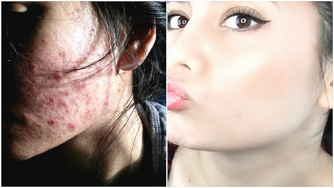 TRETINOIN PURGING | HOW TO DEAL WITH IT