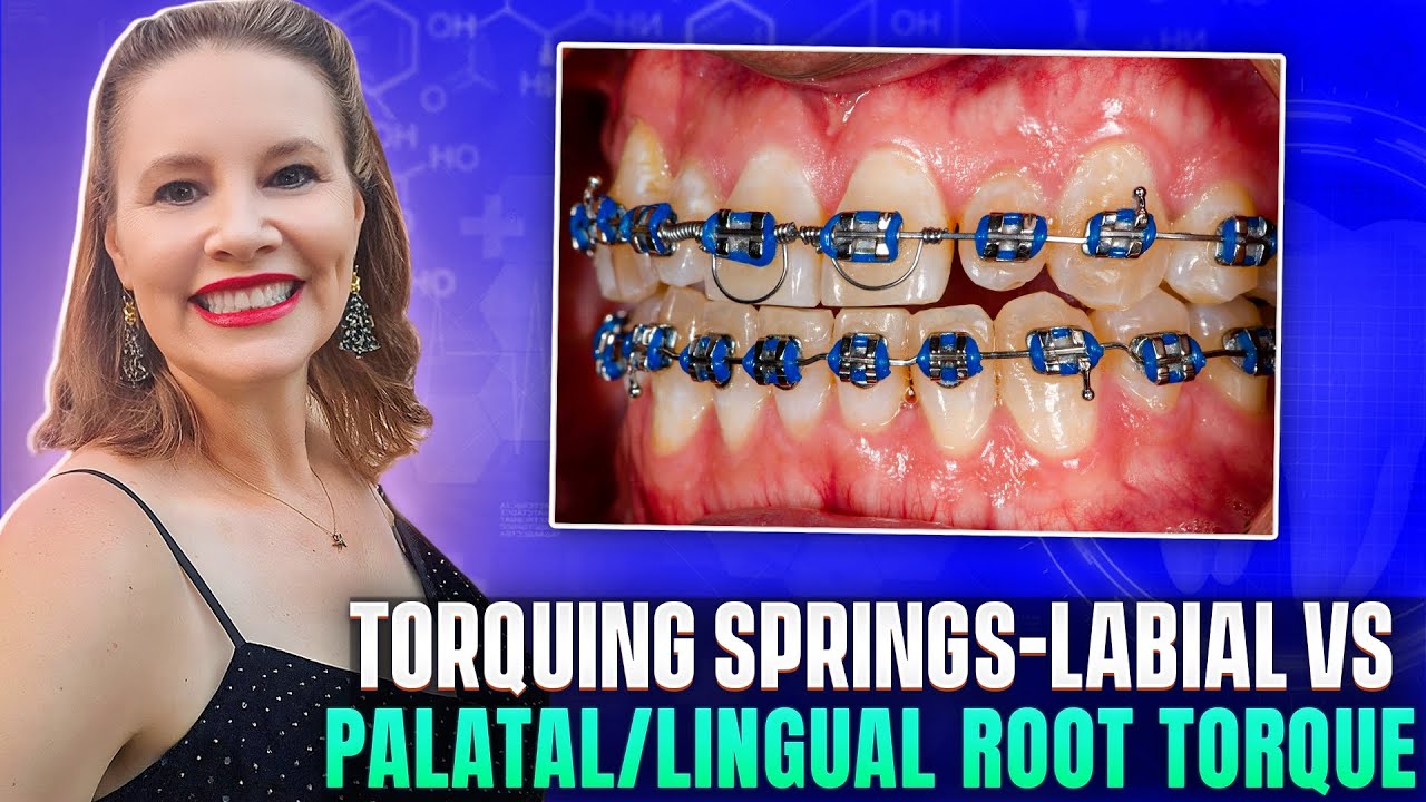 Torquing Springs-Labial vs Palatal/Lingual Root Torque