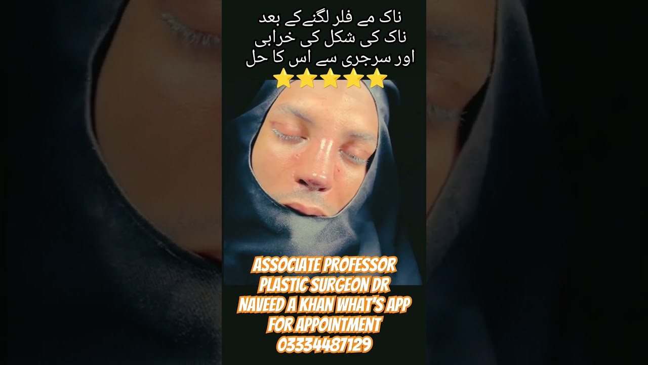 #MaleRhinoplasty#NoseSurgery#FacialSurgery#CosmeticSurgery#PlasticSurgery#MenBeauty