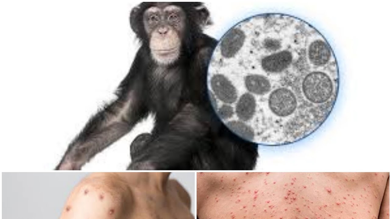 La Variole du Singe: Ce Que Vous Devez Savoir