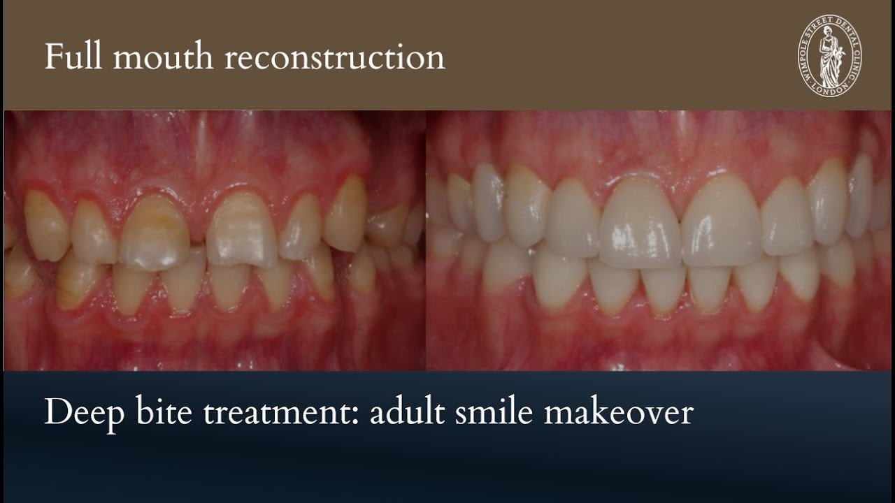 Deep bite treatment: Adult Smile Makeover // Case of the Month
