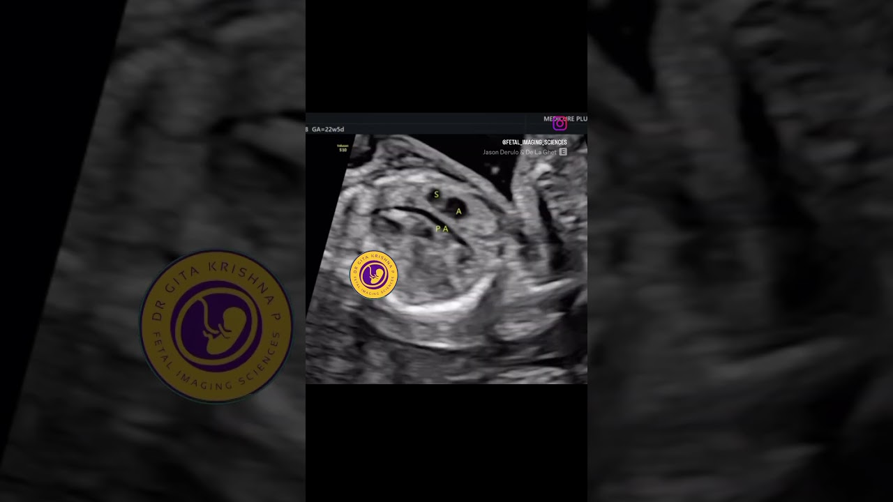 TOF with pulmonary stenosis #fetalmedicine #fetalecho #isuog #fetal #radiology #radiologist