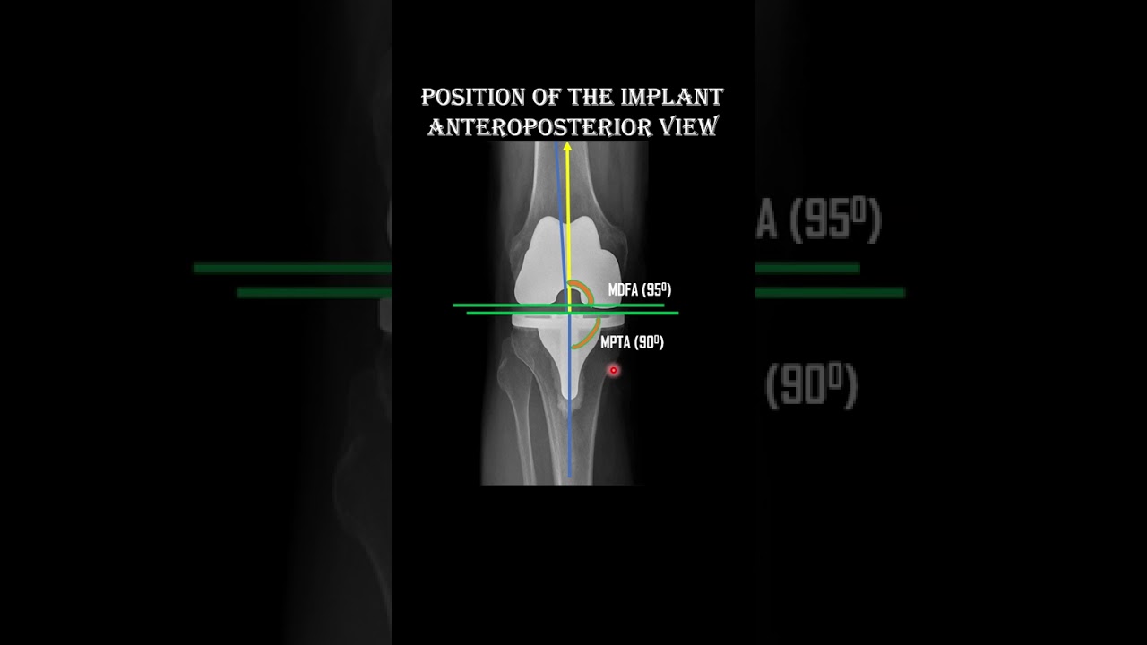 Total Knee Replacement X-Ray Assessment #kneereplacement #physiotherapist #xray #education