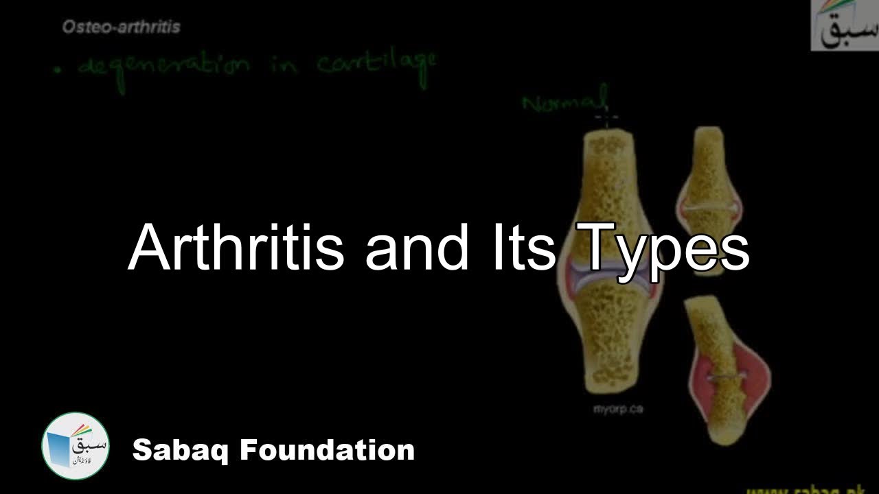 Arthritis and its Types, Biology Lecture | Sabaq.pk
