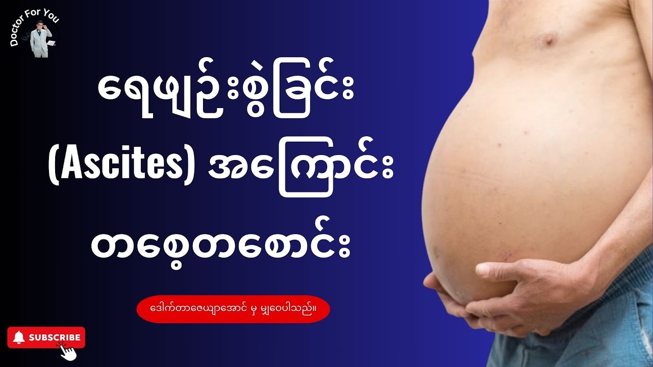 ရေဖျဉ်းစွဲခြင်း (Ascites) အကြောင်း တစေ့တစောင်း