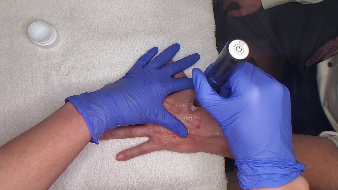 Microneedling Hands