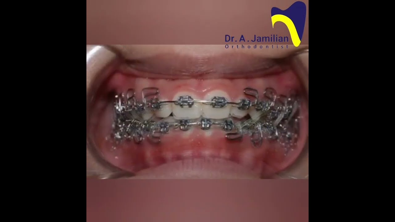 Fixed Orthodontic Treatment for Class III Malocclusion: Camouflage vs. Surgery! #brace #Class III