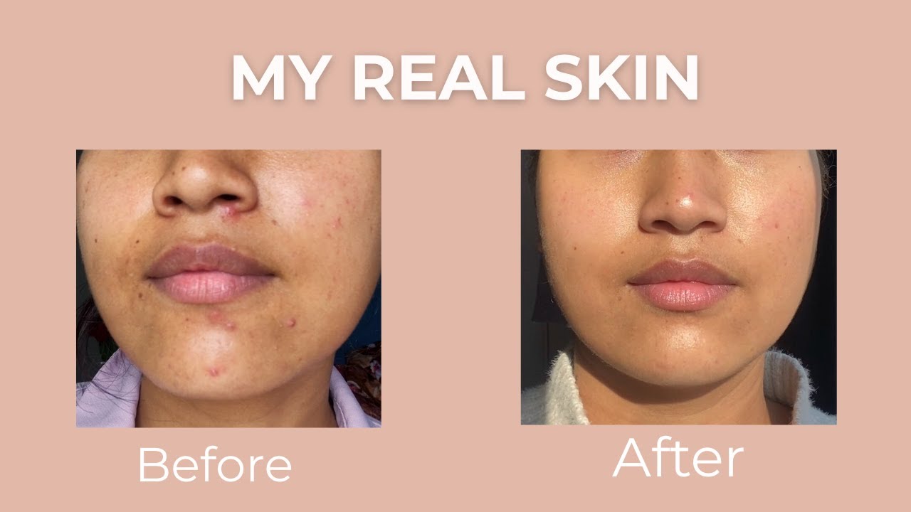 My Skin Transformation: The Journey of My Hormonal Acne and How I Treat It (2025)
