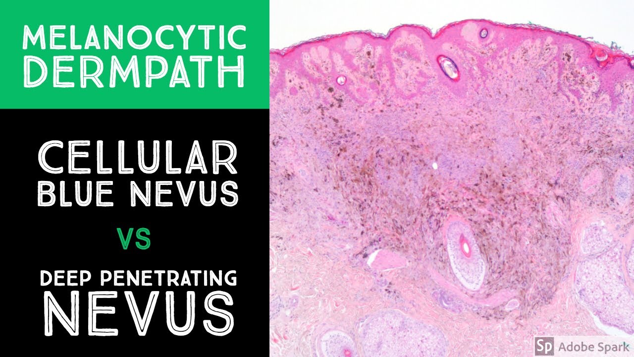 Melanocytic Dermpath: Cellular Blue Nevus vs Deep Penetrating Nevus/Melanocytoma