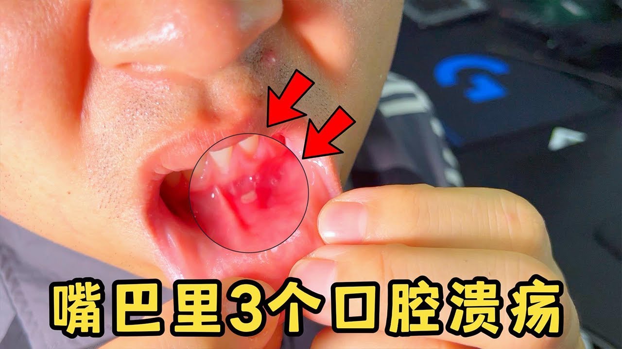 梅姐开车带阿苗去医院检查口腔溃疡，嘴巴里长3个口腔溃疡，真疼