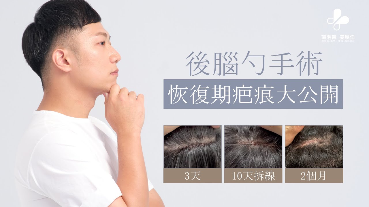 📍#3D後腦勺植入手術｜恢復期疤痕大公開