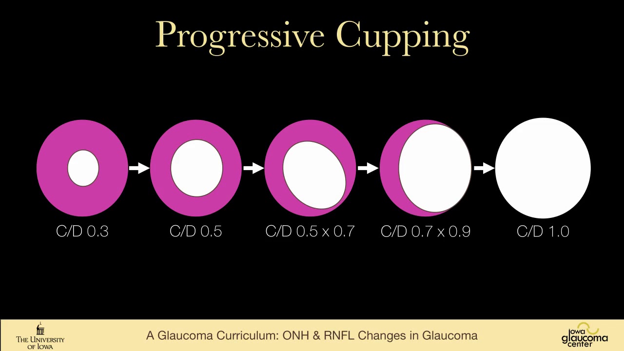 09  ONH & RNFL changes in glaucoma