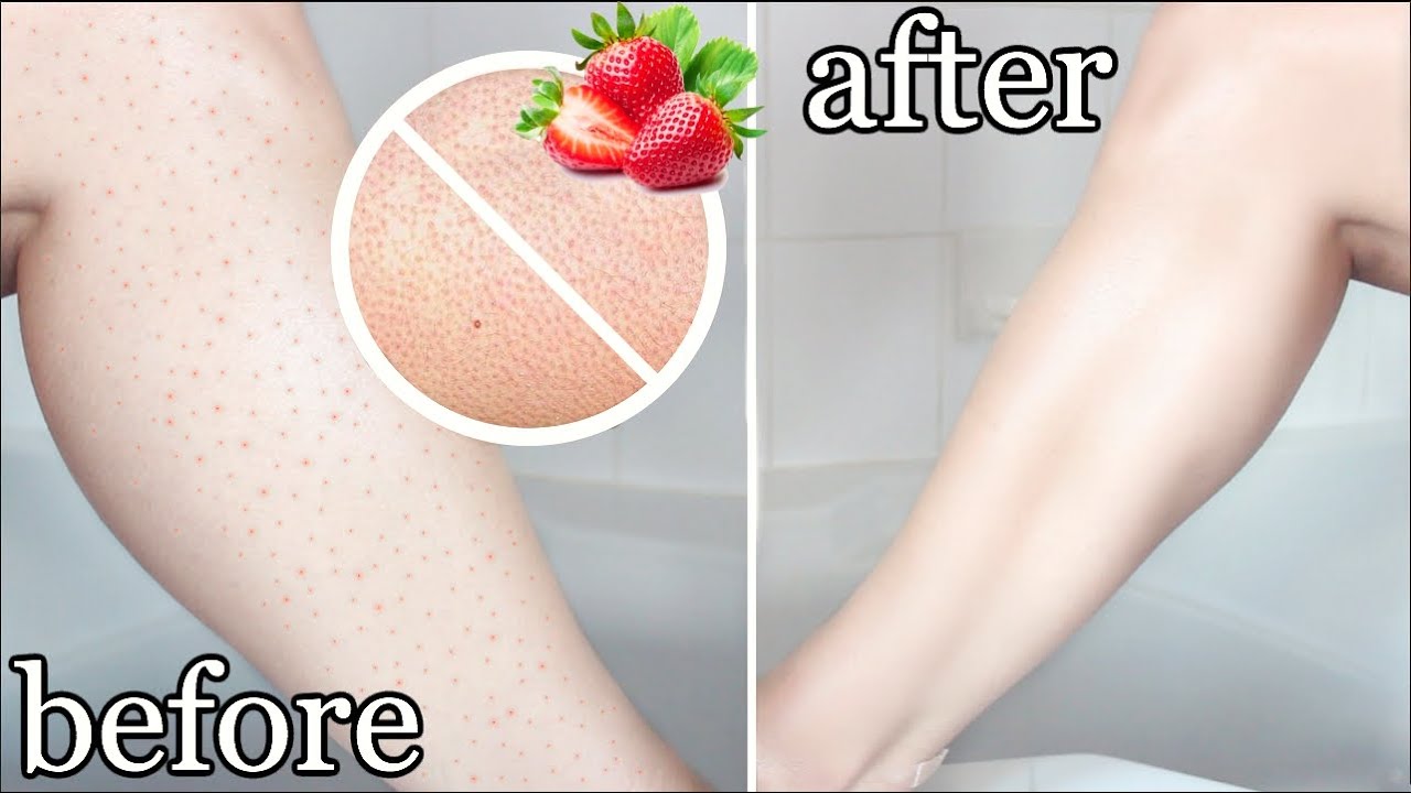 How To Get Rid Of STRAWBERRY LEGS OVERNIGHT !!