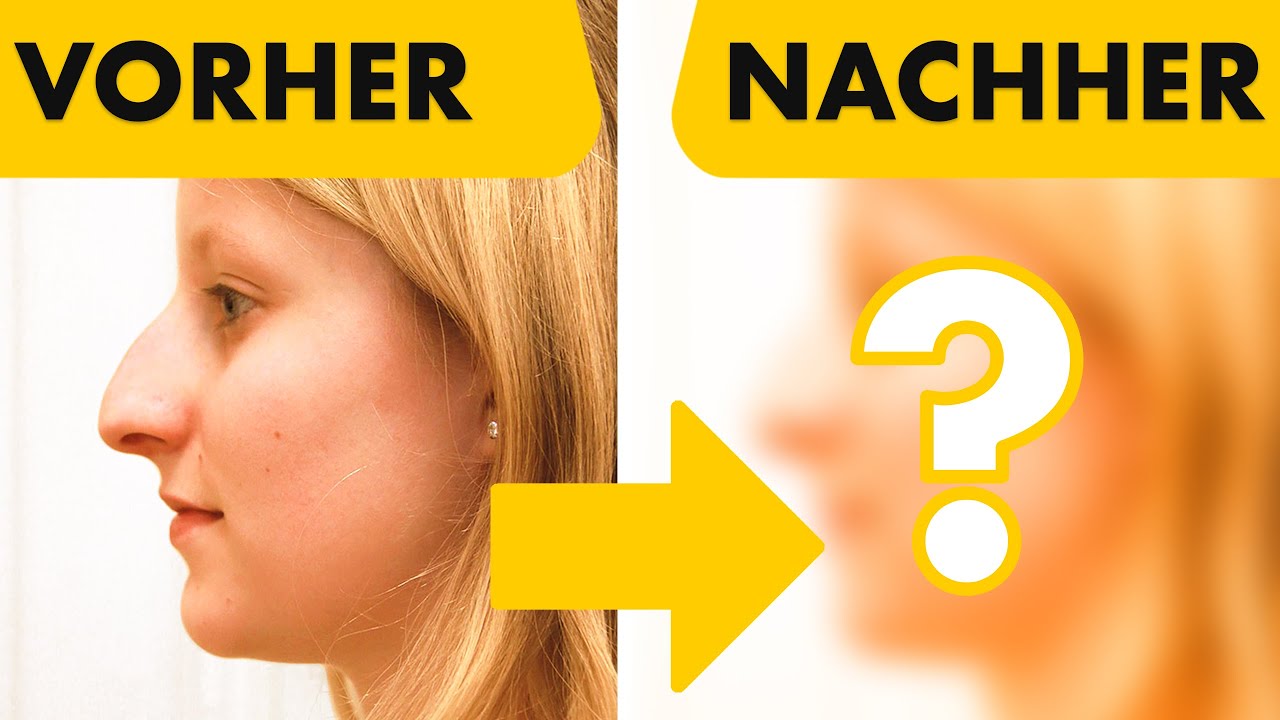 Geschlossene Nasen-OP an zwei 20-j&auml;hrigen Patientinnen - VORHER / NACHHER Ergebnis | Dr. Jungwirth