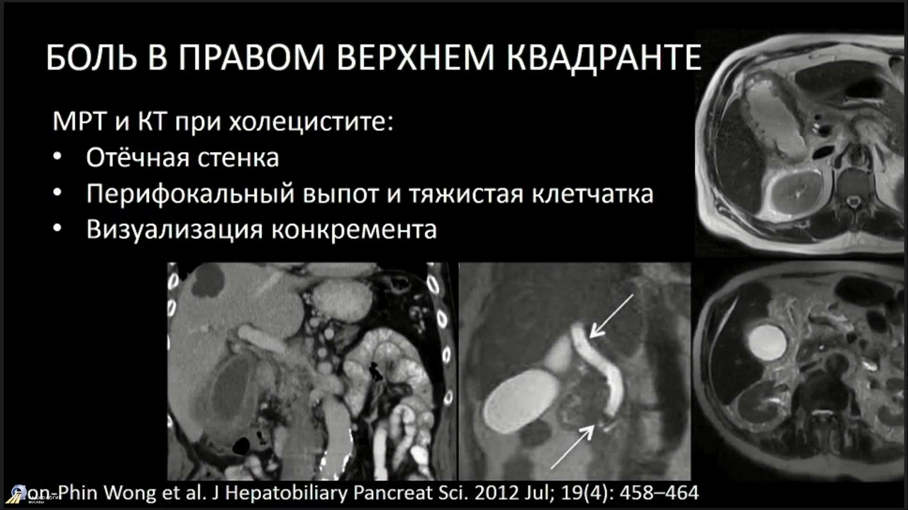 Острый живот выбор метода лучевой диагностики