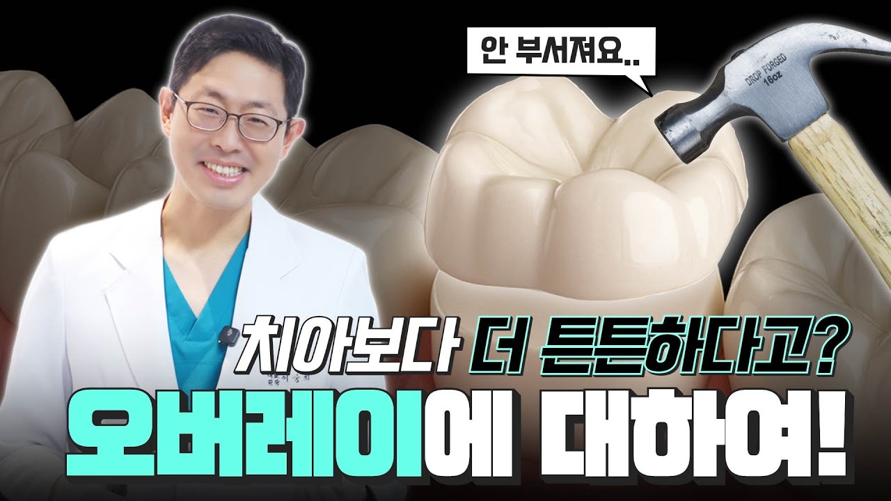 [부평치과-해피스치과] 망치로 두드려도 깨지지 않는 오버레이크라운? 필요한 부분만 정밀 복원하세요!✨