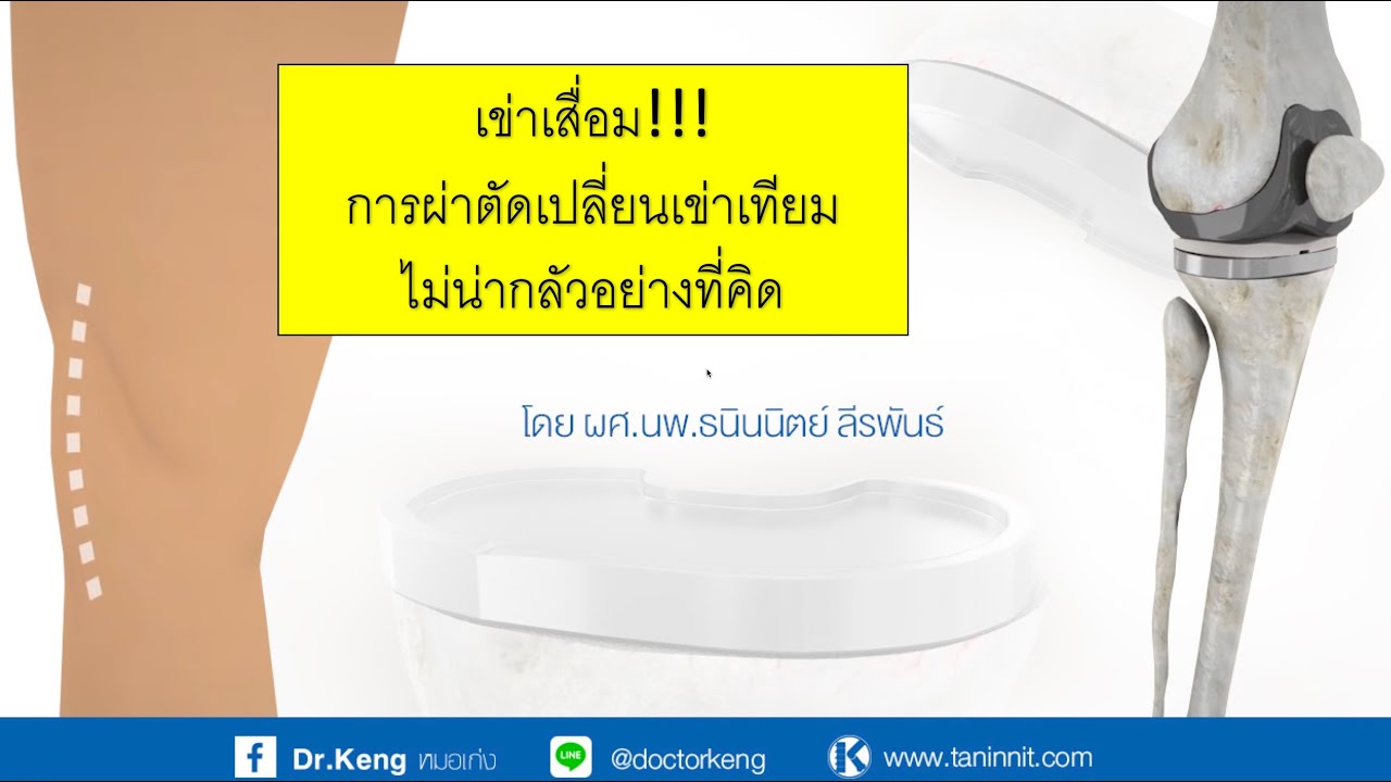 เข่าเสื่อม การผ่าตัดเปลี่ยนเข่าเทียม ไม่น่ากลัวอย่างที่คิด