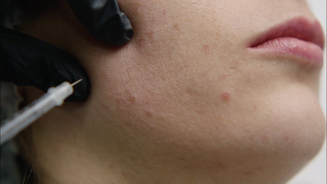 Ботокс в долната част на лицето в Derma-Act