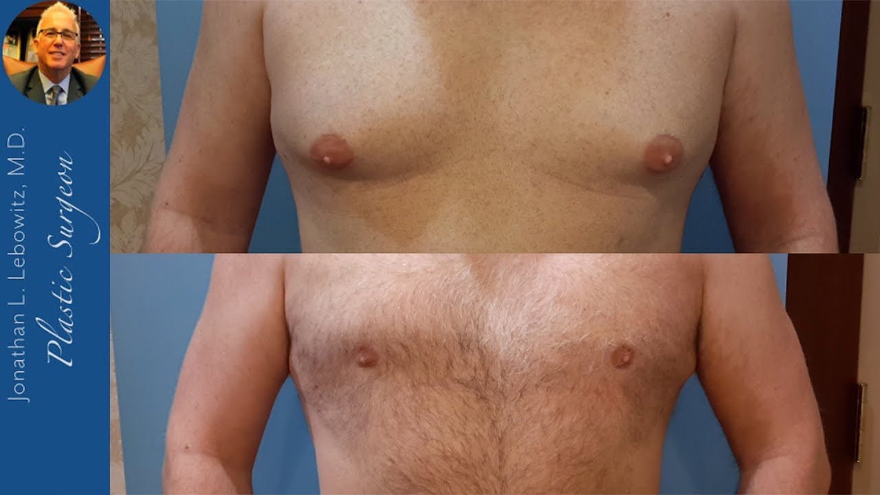 Gynecomastia VaserLipo Before & After Chest & Body Contouring Surgery By Dr. Lebowitz Long Island NY