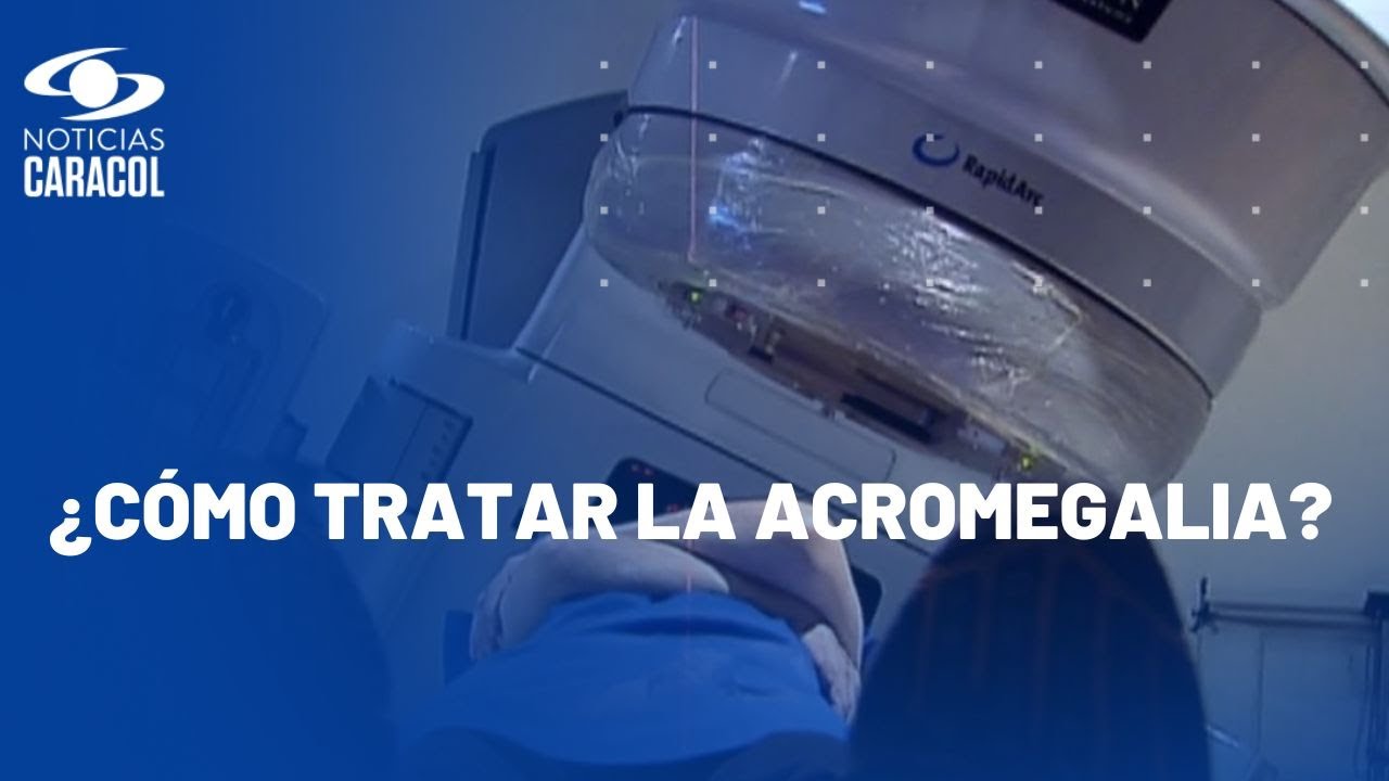 Abecé de la acromegalia: todo lo que debe saber sobre este extraño trastorno