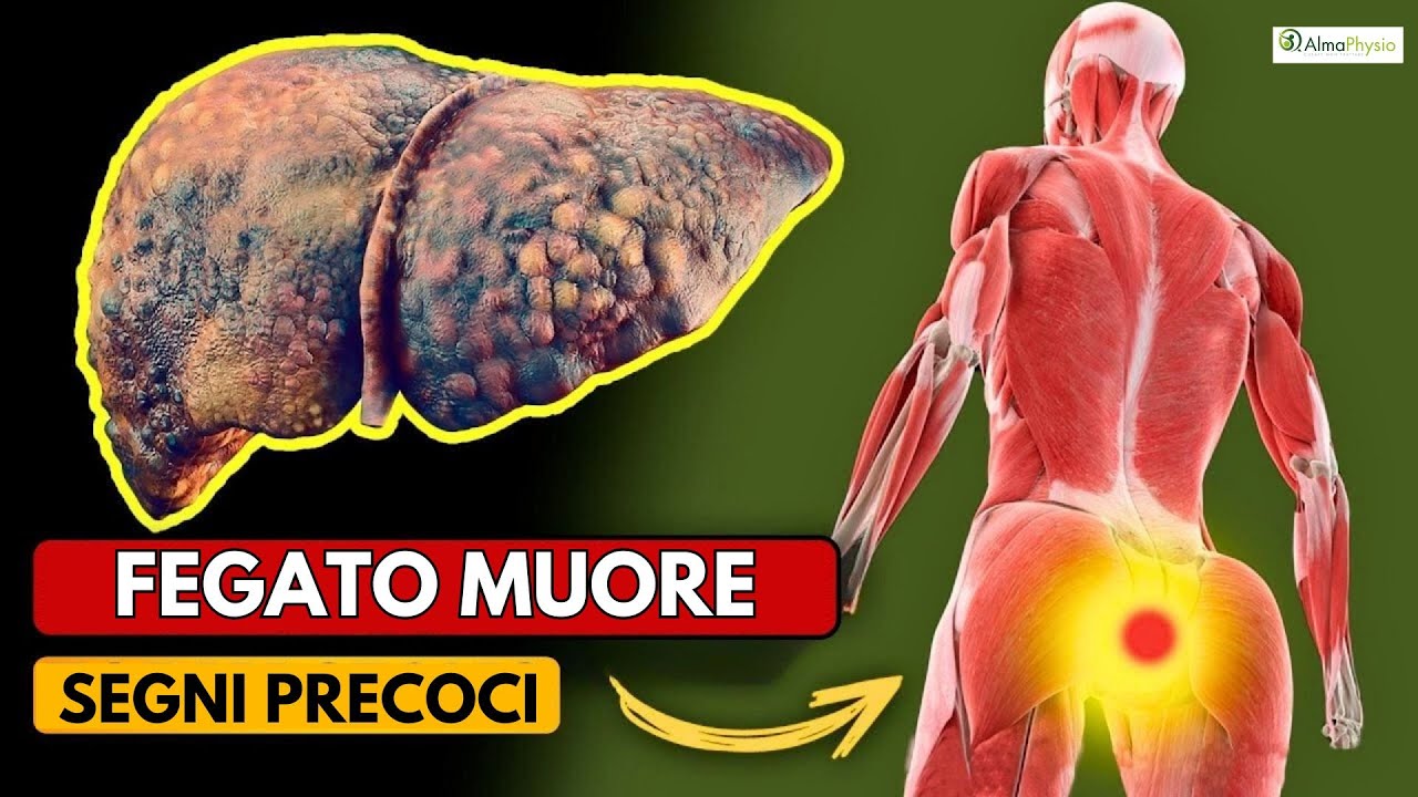 i SEGNI PRECOCI di CIRROSI EPATICA / il tuo fegato sta morendo!