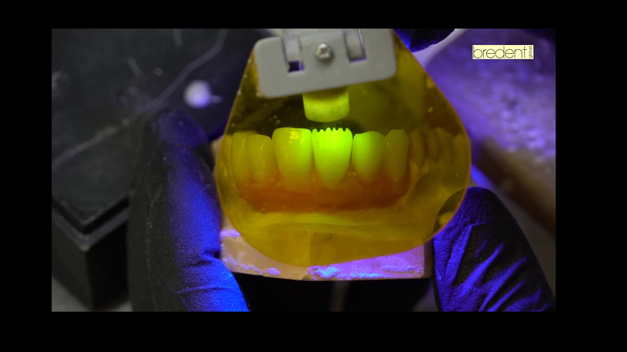 Cutback de los dientes centrales y personalizacion