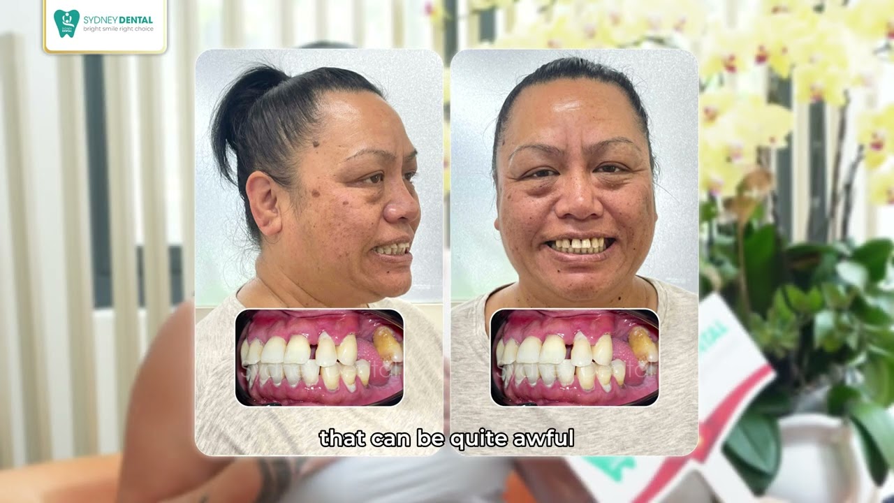 First Smile in Years! Teresa&rsquo;s All-on-6 Journey