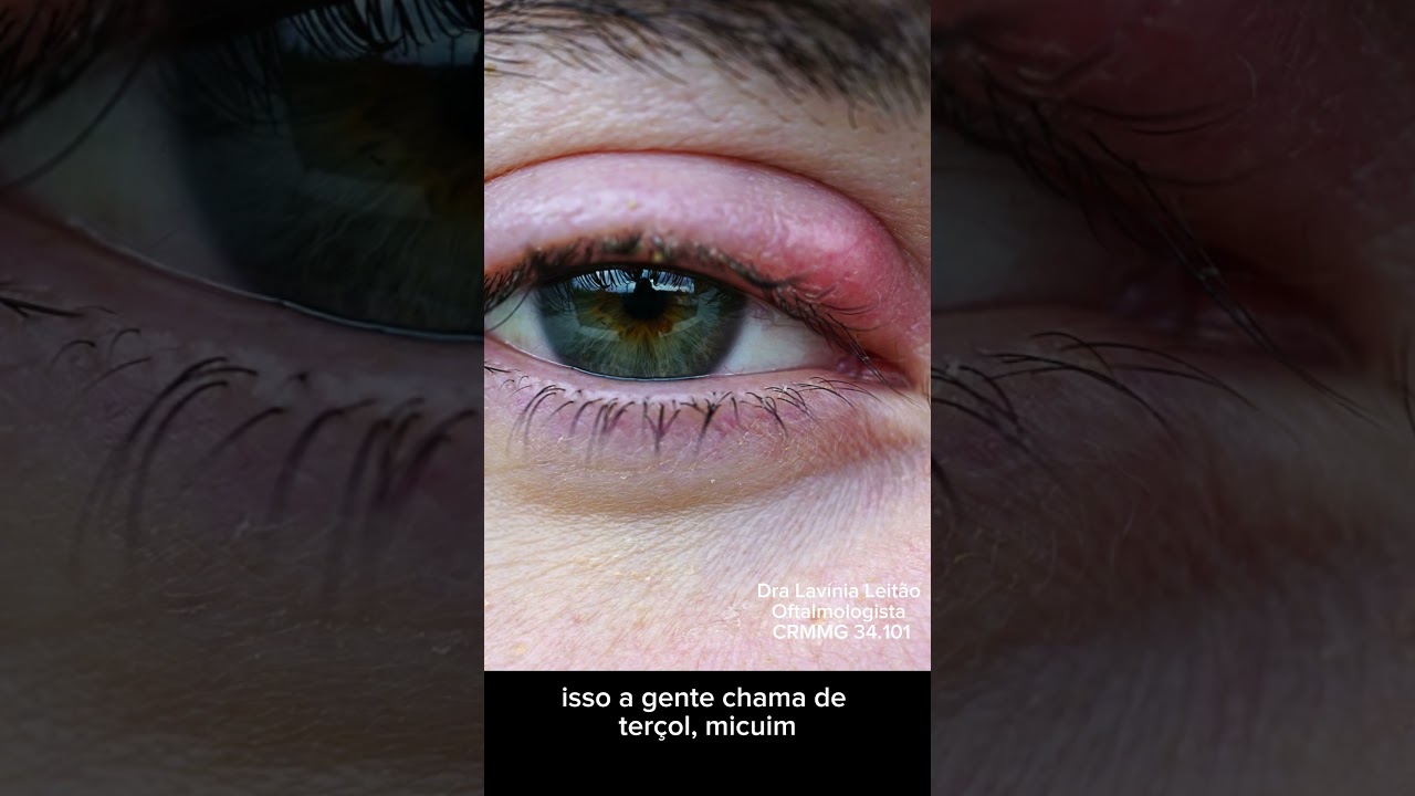 Como tratar ter&ccedil;ol?