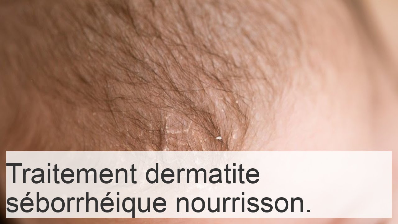 Croûtes sur la tête du nourrisson : comment enlever les squames séborrhéiques (Komarovski)