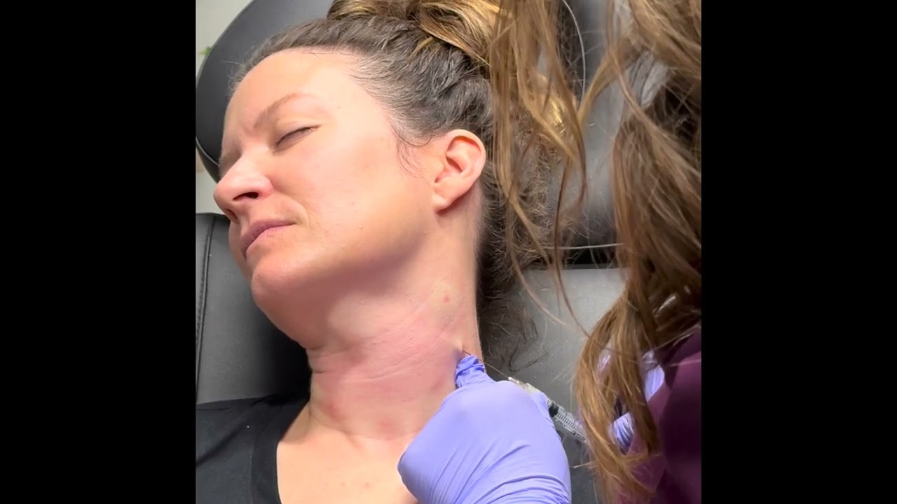 Hyper-dilute Radiesse to neck, followed by RF microneedling