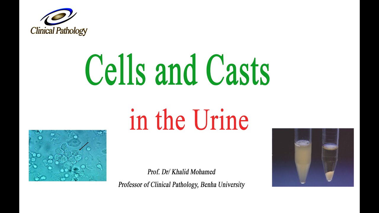 Urine analysis Part 3: cells and casts in urine sediment