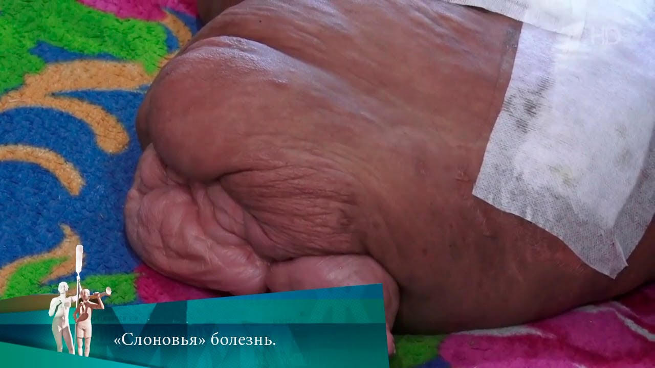 МЖ.  &laquo;Слоновья&raquo; болезнь. 18.05.2023